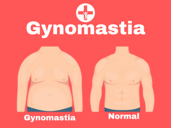 Gynomastia