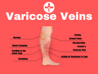 Varicose Veins