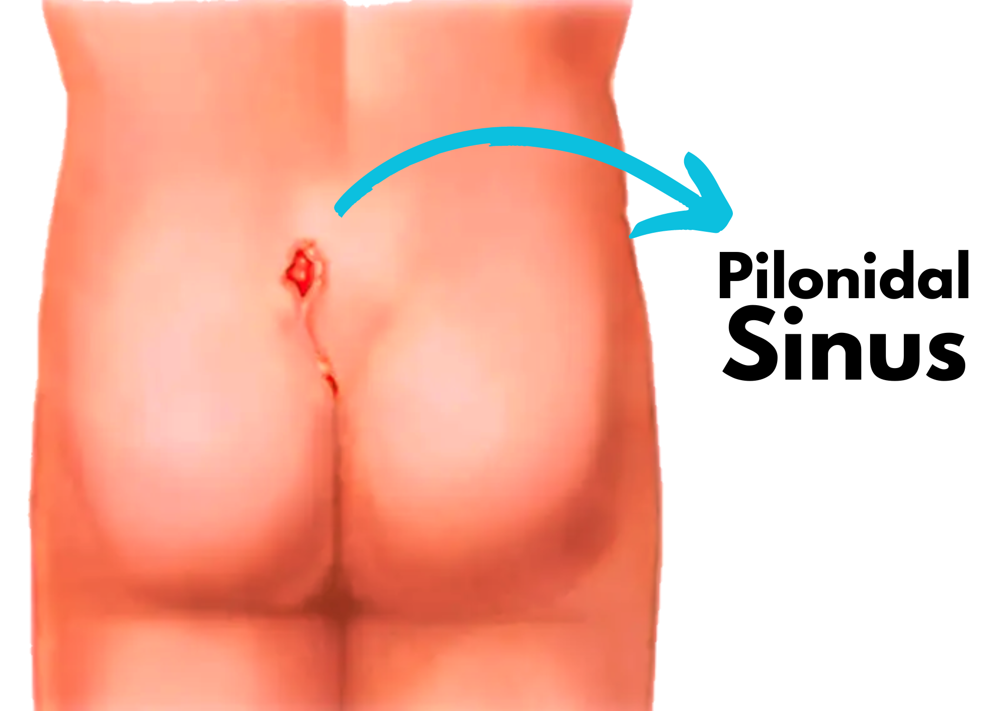 Pilonidal Sinus Doctor in Indore