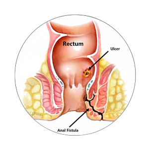 Fistula page link