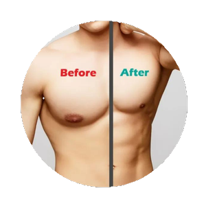 Gynecomastia page link