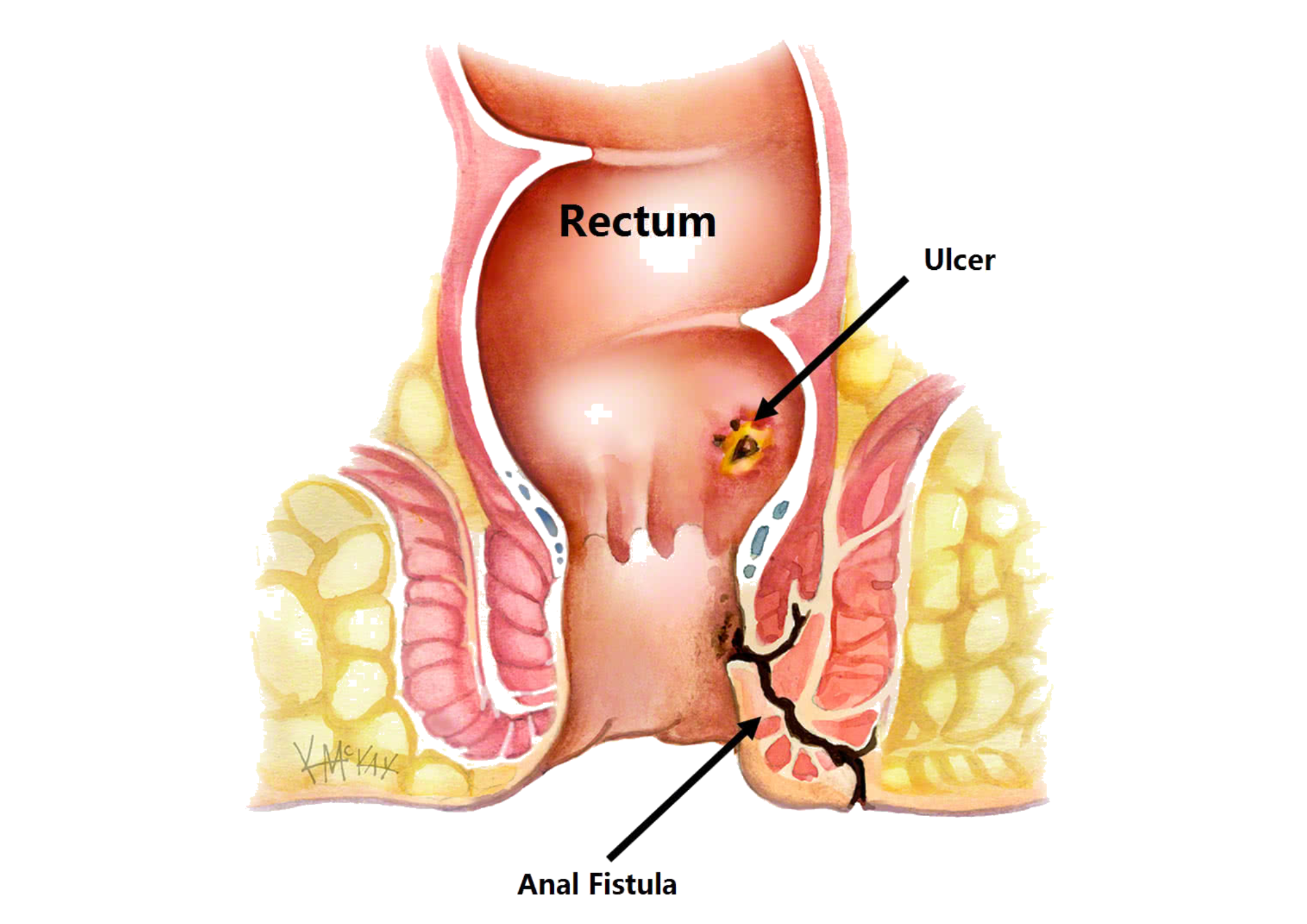 Fistula Doctor in Indore